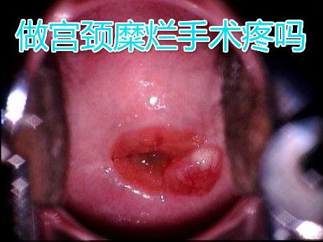 宫颈糜烂手术视频,专业视角下的医学实践