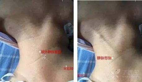 静脉穿刺视频,轻松掌握穿刺技巧